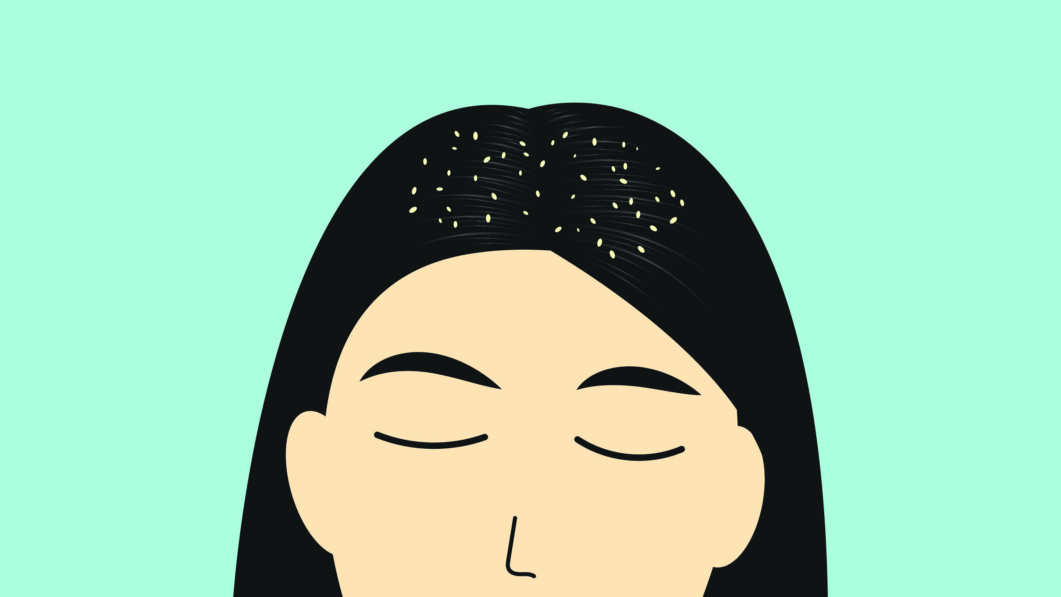 dandruff