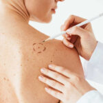 How Does Uveal Melanoma Spread?
