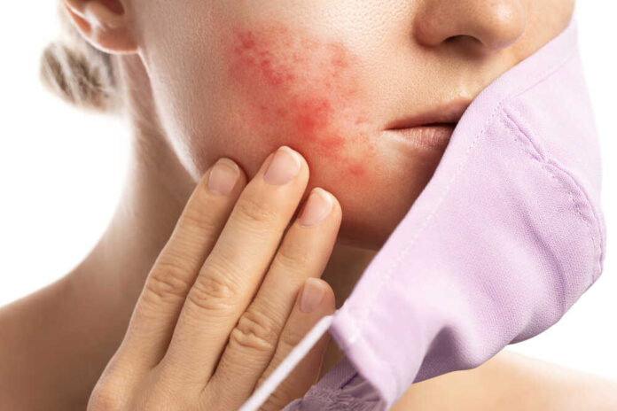 Young,Woman,With,Prevention,Mask,And,Skin,Irritation,On,White