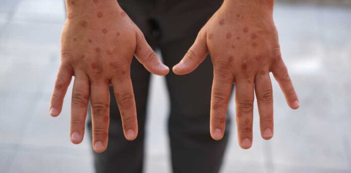 Men's,Hands,Showing,Rash,Due,To,Pox,Viral,Infection,Painful